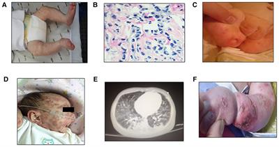 Case report: De novo SAMD9L truncation causes neonatal-onset autoinflammatory syndrome which was successfully treated with hematopoietic stem cell transplantation